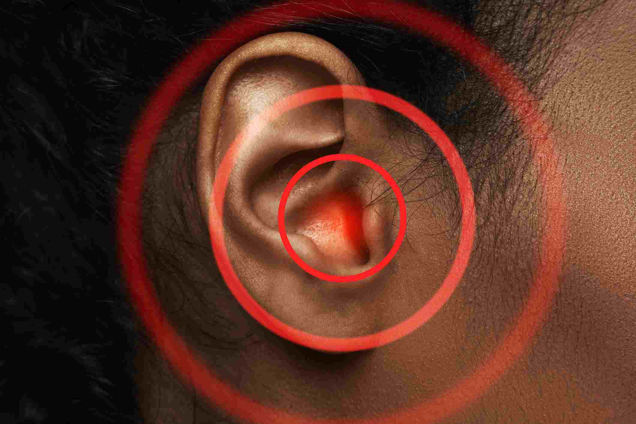 Tinnitus Management in Naples and Estero, FL